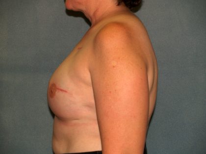 Breast Reconstruction Before & After Patient #2195