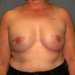 Breast Reconstruction Before & After Patient #2195