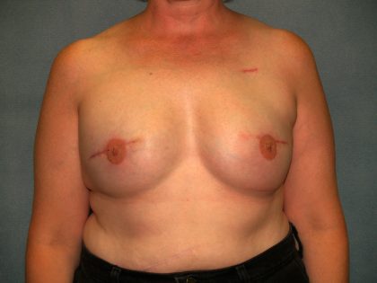 Breast Reconstruction Before & After Patient #2195