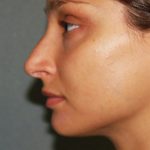 Nose Surgery Before & After Patient #834