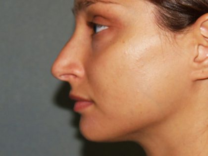 Nose Surgery Before & After Patient #834