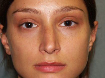 Nose Surgery Before & After Patient #834