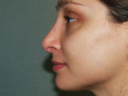 Nose Surgery Before & After Patient #834