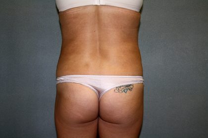 Liposuction Before & After Patient #3805