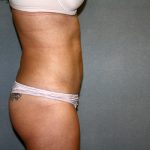 Liposuction Before & After Patient #3805