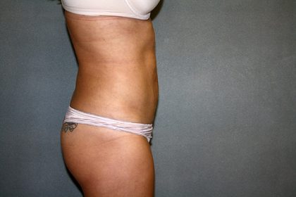 Liposuction Before & After Patient #3805