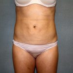 Liposuction Before & After Patient #3805