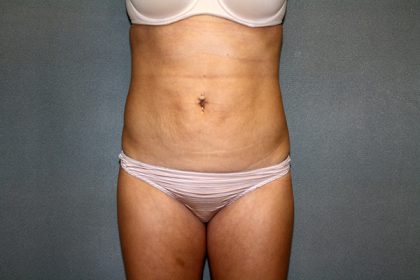 Liposuction Before & After Patient #3805