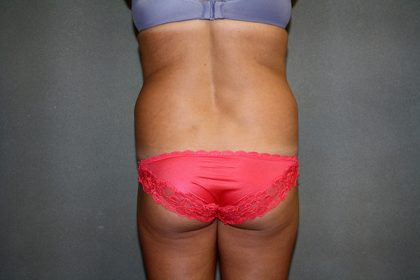 Liposuction Before & After Patient #3805