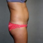 Liposuction Before & After Patient #3805