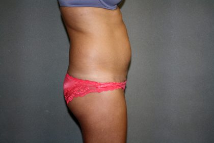 Liposuction Before & After Patient #3805