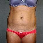 Liposuction Before & After Patient #3805