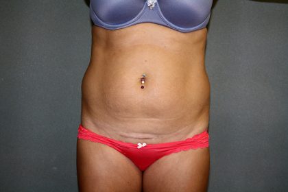 Liposuction Before & After Patient #3805