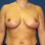 Breast Lift Before & After Patient #3493