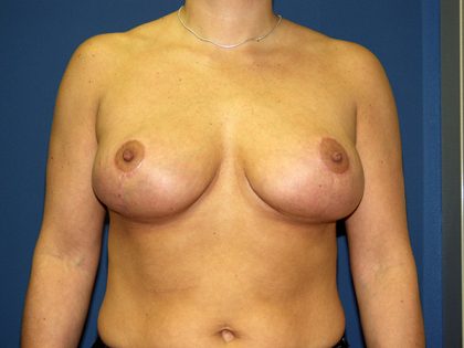 Breast Lift Before & After Patient #3493