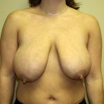 Breast Lift Before & After Patient #3493