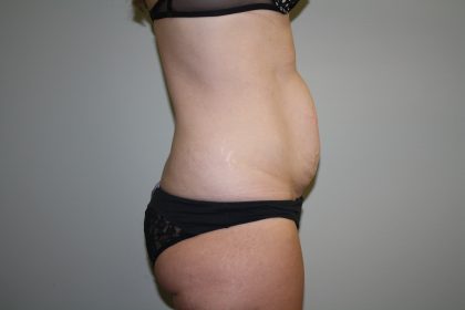 Tummy Tuck Before & After Patient #1990