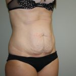 Tummy Tuck Before & After Patient #1990