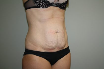 Tummy Tuck Before & After Patient #1990