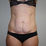 Tummy Tuck Before & After Patient #1990