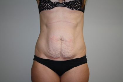 Tummy Tuck Before & After Patient #1990