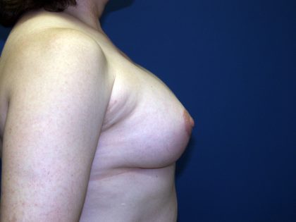 Breast Lift with Implant Before & After Patient #1516