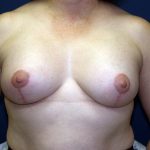 Breast Lift with Implant Before & After Patient #1516