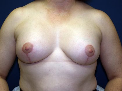 Breast Lift with Implant Before & After Patient #1516