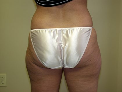 Liposuction Before & After Patient #3720