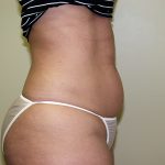 Liposuction Before & After Patient #3720