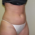 Liposuction Before & After Patient #3720