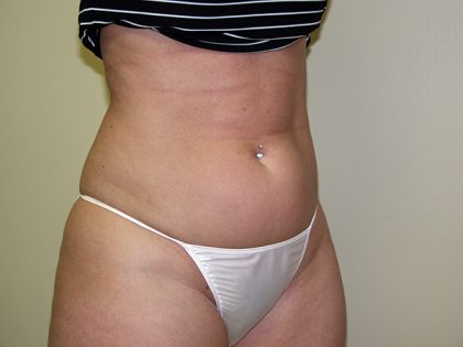 Liposuction Before & After Patient #3720