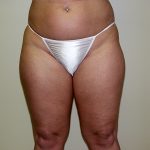 Liposuction Before & After Patient #3720