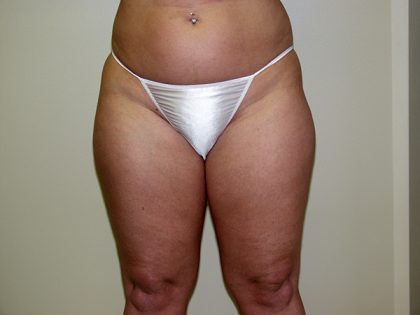 Liposuction Before & After Patient #3720