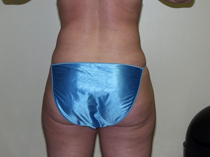 Liposuction Before & After Patient #3720