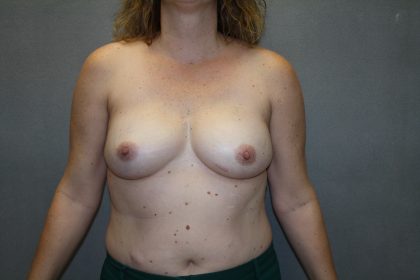 Breast Reconstruction Before & After Patient #2032