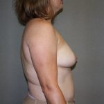 Breast Reconstruction Before & After Patient #2032