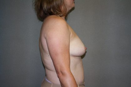 Breast Reconstruction Before & After Patient #2032