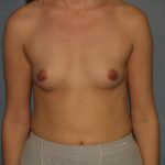 Breast Augmentation Before & After Patient #3187