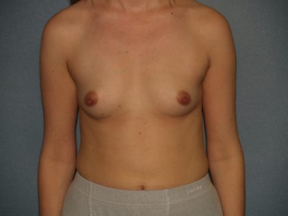 Breast Augmentation Before & After Patient #3187