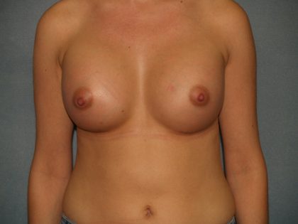 Breast Augmentation Before & After Patient #3187