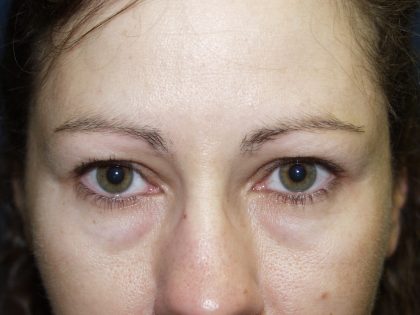 CO2 Laser Before & After Patient #712
