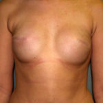 Breast Reconstruction Before & After Patient #1711