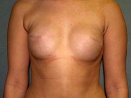 Breast Reconstruction Before & After Patient #1711