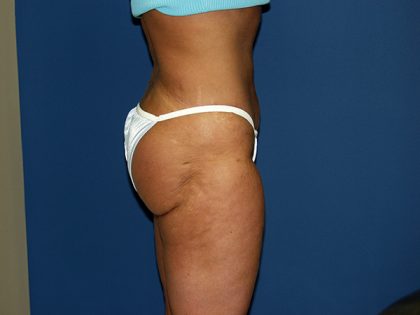 Liposuction Before & After Patient #3817