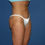 Liposuction Before & After Patient #3817