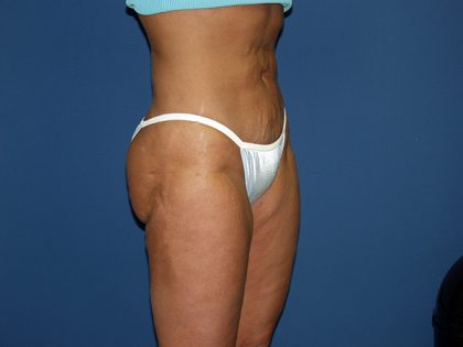 Liposuction Before & After Patient #3817