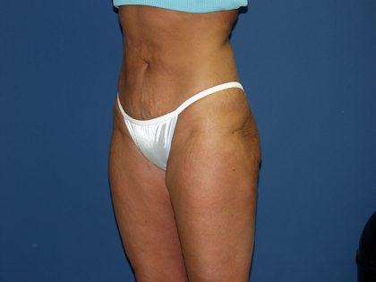 Liposuction Before & After Patient #3817