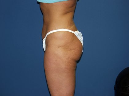 Liposuction Before & After Patient #3817