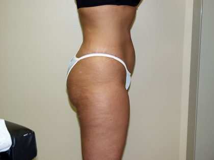 Liposuction Before & After Patient #3817